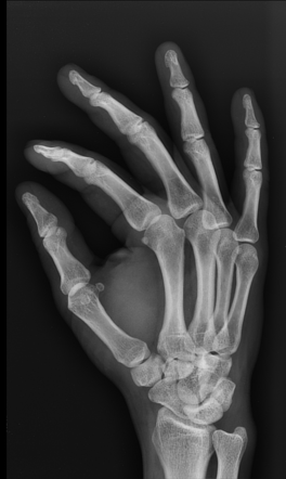 Foreign body in hand | Radiology Case | Radiopaedia.org