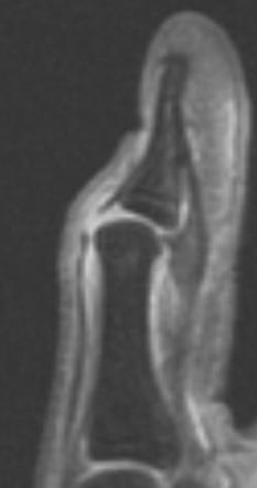 Mallet thumb | Radiology Case | Radiopaedia.org