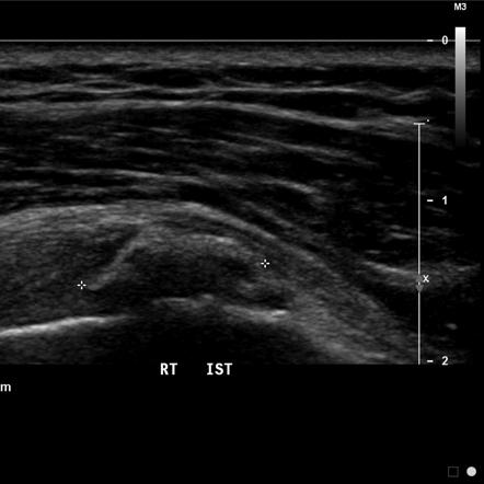 Calcific Tendinitis | Radiology Reference Article | Radiopaedia.org