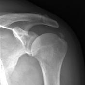 Calcific Tendinitis Radiology Reference Article Radiopaedia Org