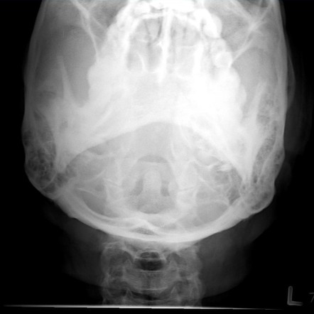 Cervical Spine Fuchs View Radiology Reference Article Radiopaedia Org