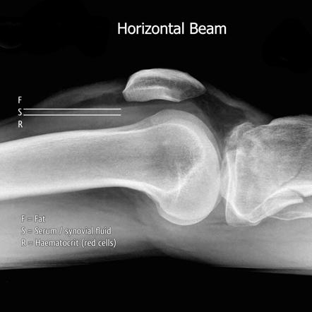 Lipohaemarthrosis | Radiology Reference Article | Radiopaedia.org