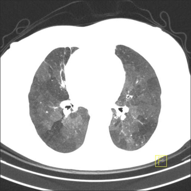 Radiology Quiz 14799 | Radiopaedia.org | Playlist 'Mosaic 