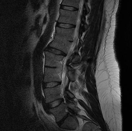 Block vertebrae (MRI) | Radiology Case | Radiopaedia.org