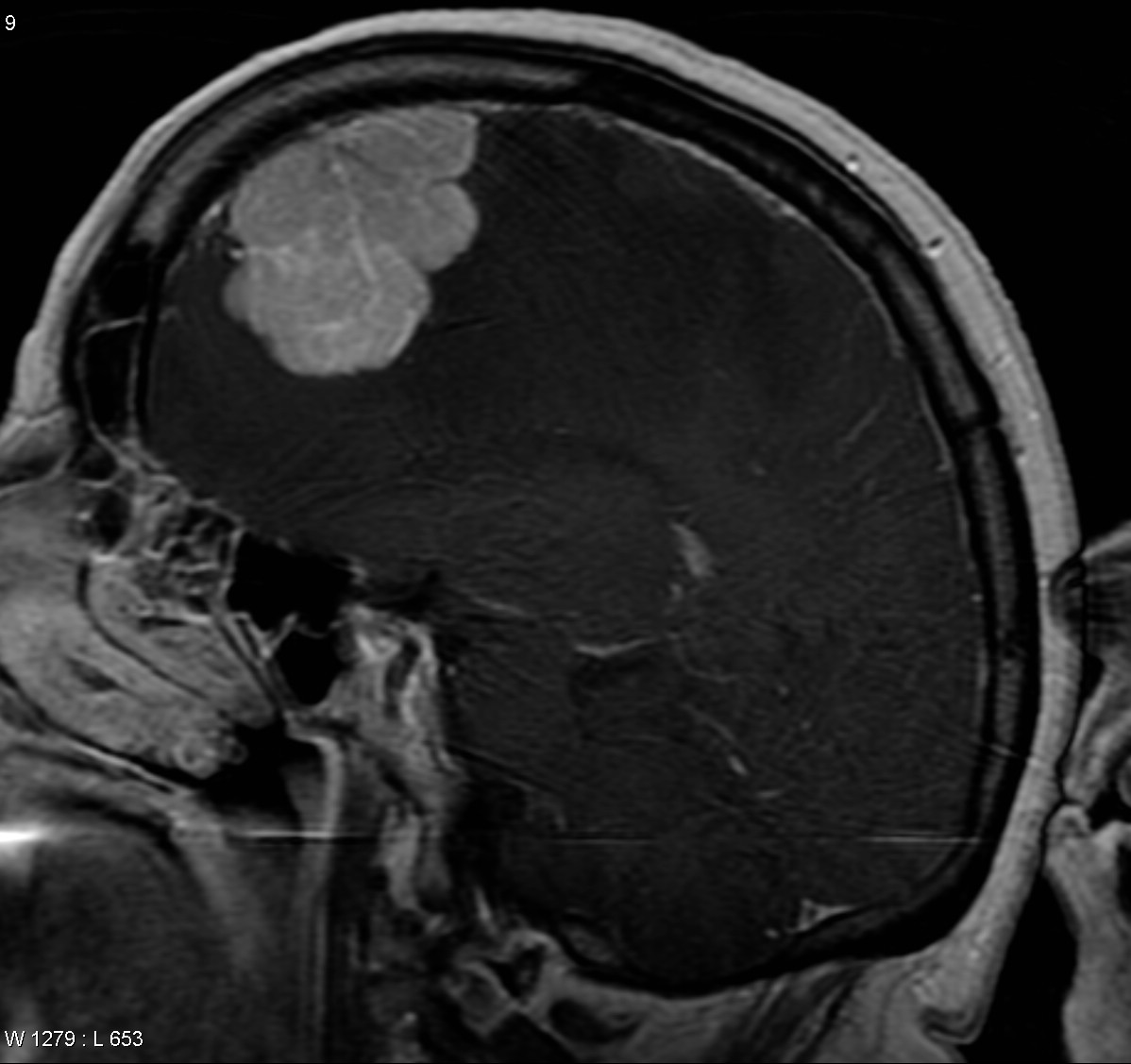 Intracranial Metastatic Liposarcoma 