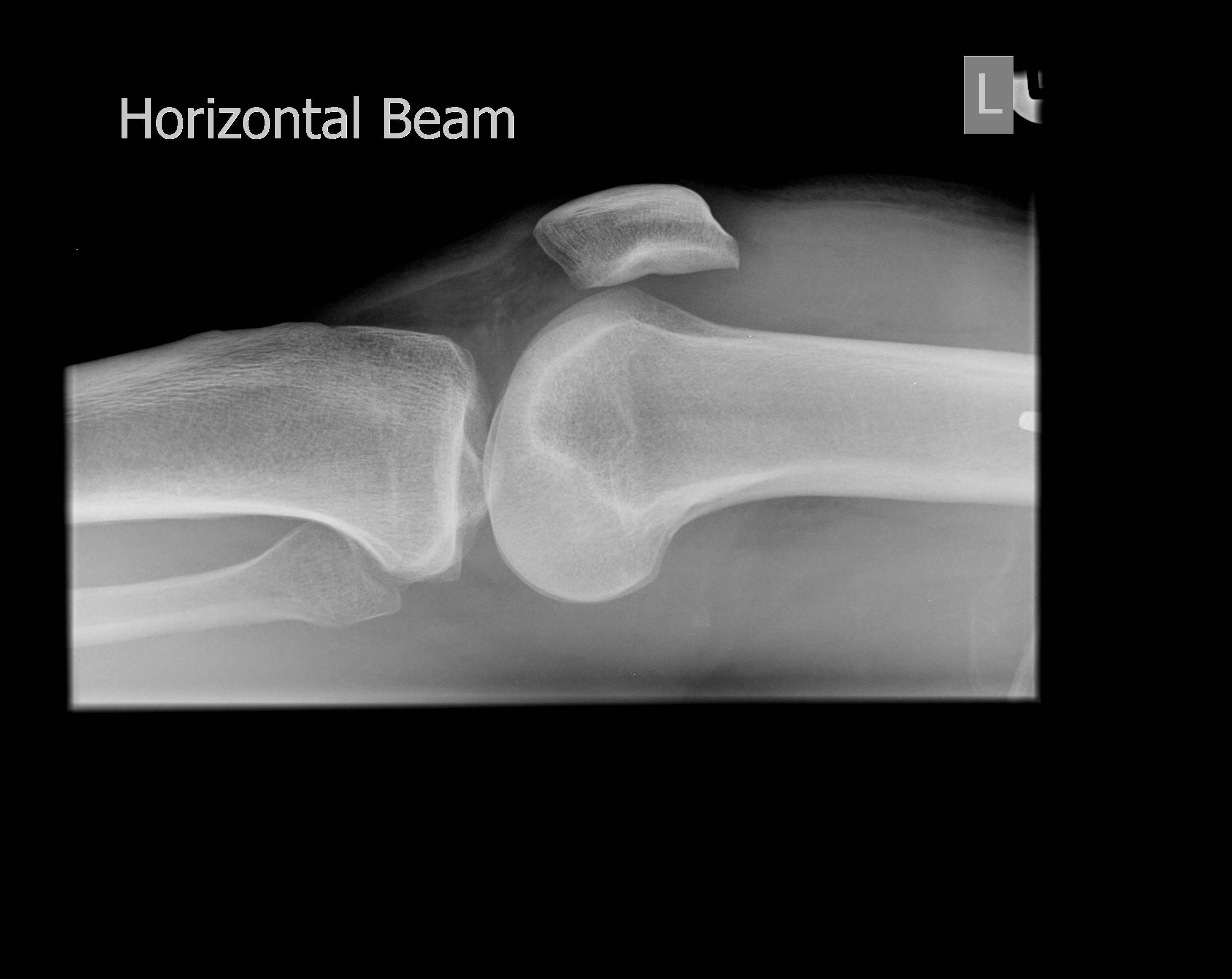 Knee Joint Effusion Ultrasound