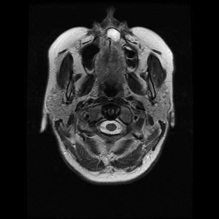 Incisive canal cyst | Radiology Case | Radiopaedia.org