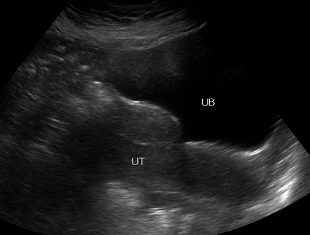 Uterovesical Fistula