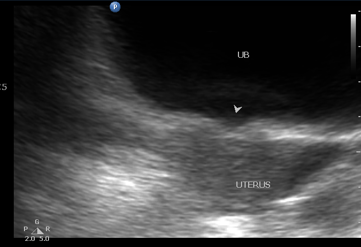 Vesico-uterine fistula | Image | Radiopaedia.org