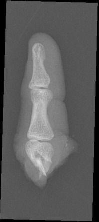 Traumatic finger amputation | Image | Radiopaedia.org