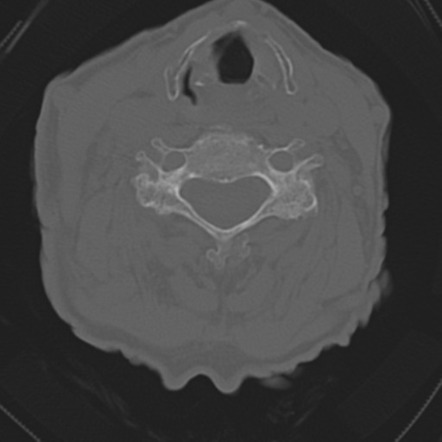 C2 fracture with vertebral artery dissection | Radiology Case ...