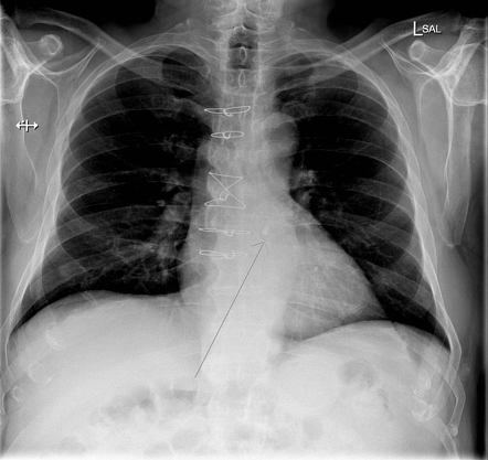 Left atrial appendage occlusion device | Radiology Case | Radiopaedia.org