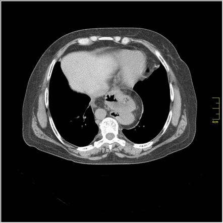 Hiatus hernia | Radiology Reference Article | Radiopaedia.org