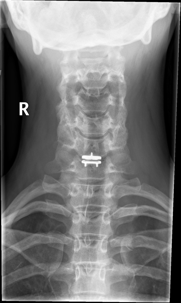 Cervical Disc Replacement Radiology Case Radiopaedia Org