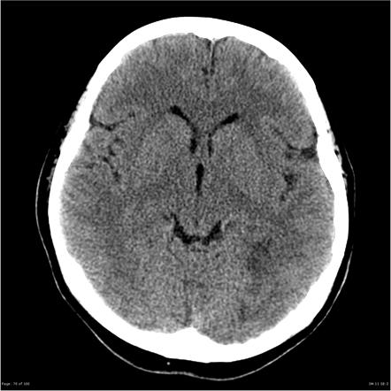 Cerebral angiitis | Radiology Case | Radiopaedia.org