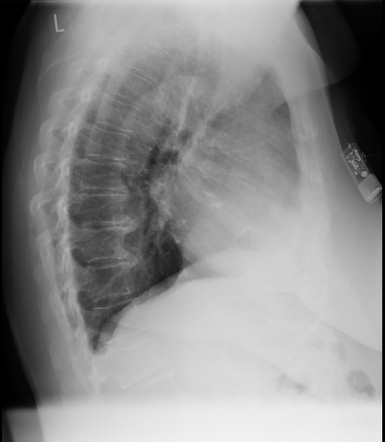 Medical devices in the thorax | Radiology Reference Article ...