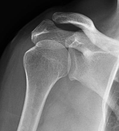 Acromial spur | Radiology Case | Radiopaedia.org