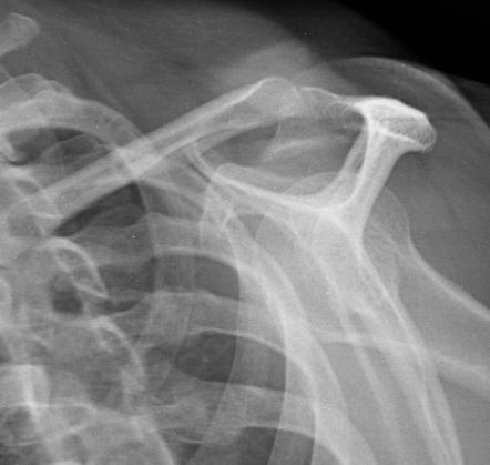 Acromial spur | Image | Radiopaedia.org