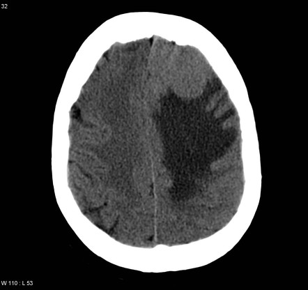 Intracranial metastatic liposarcoma | Radiology Case | Radiopaedia.org