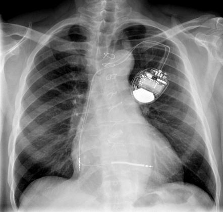 Dislodged right atrial lead | Radiology Case | Radiopaedia.org