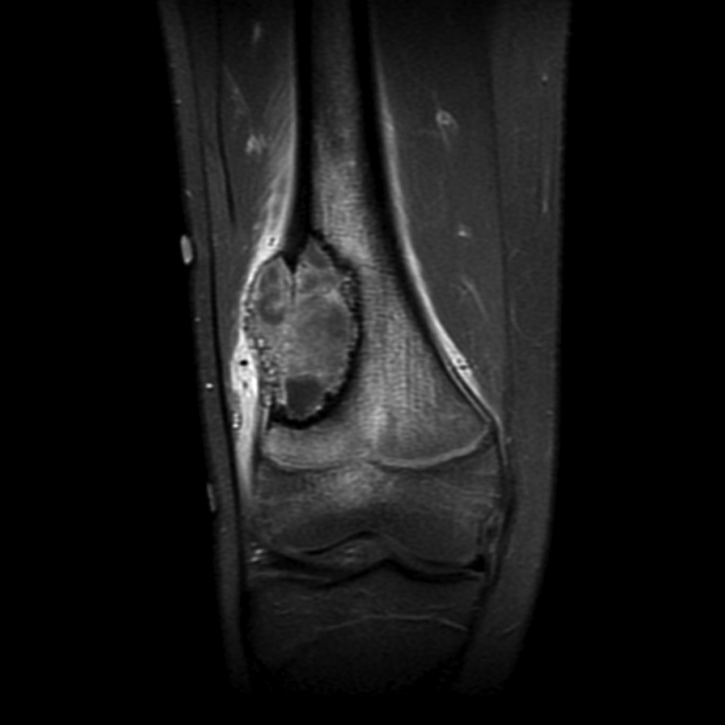 Саркома кт. Саркома большеберцовой кости мрт. Саркома Юинга бедренной кости мрт. Остеосаркома бедренной кости мрт. Саркома Юинга большеберцовой кости кт.