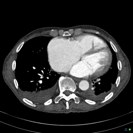 hepatic congestion radiopaedia venous