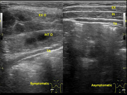 Anterior abdominal wall abscess | Radiology Case | Radiopaedia.org