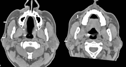 Parotid Duct Obstruction