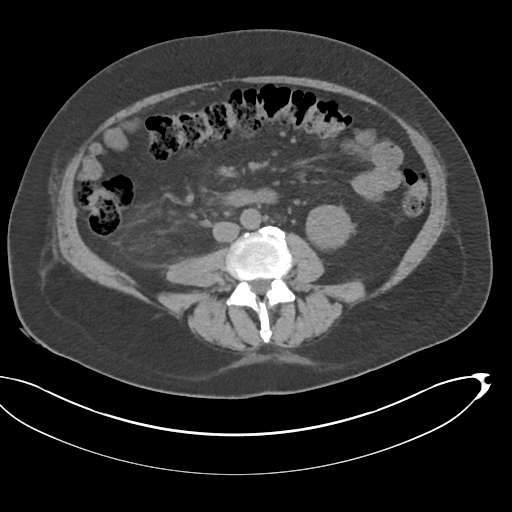 Cystgastrostomy stent | Image | Radiopaedia.org