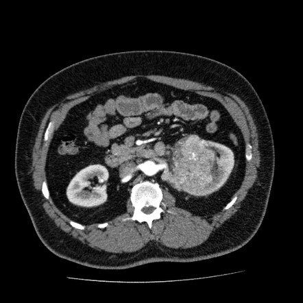 Renal cell carcinoma | Radiology Case | Radiopaedia.org