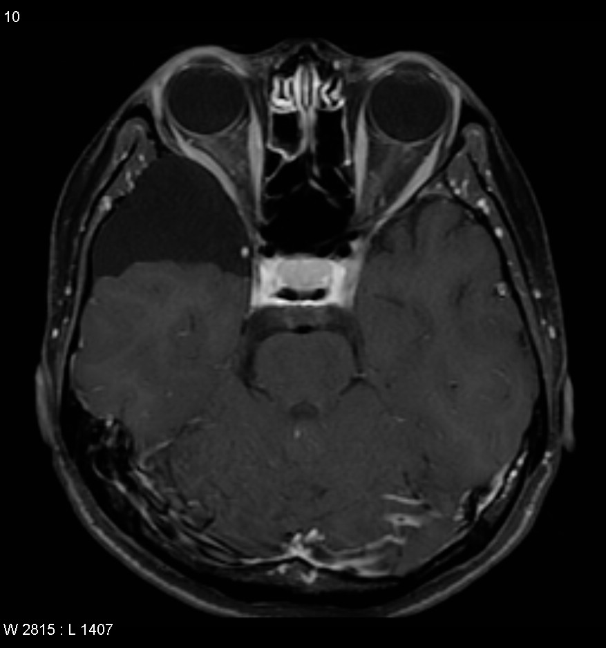 Arachnoid cyst - middle cranial fossa | Image | Radiopaedia.org