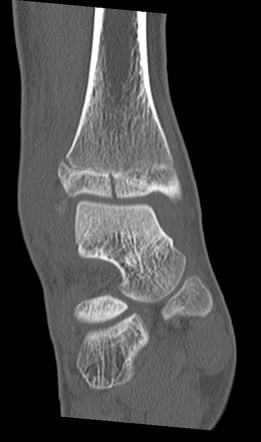 metatarsal fracture