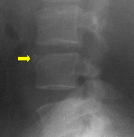 Limbus vertebra | Radiology Reference Article | Radiopaedia.org