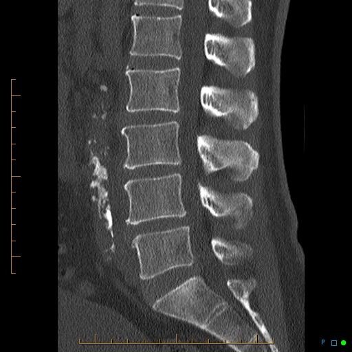 Lumbar vertebral osteomyelitis (sans discitis) | Image | Radiopaedia.org