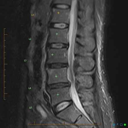 Lumbar vertebral osteomyelitis (sans discitis) | Image | Radiopaedia.org