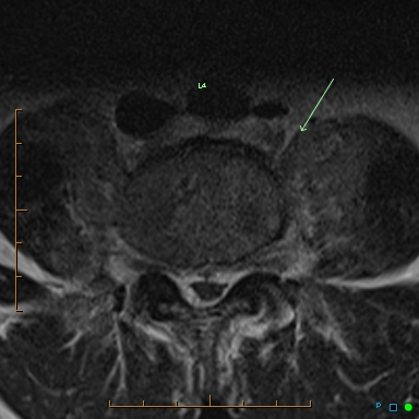 Lumbar Vertebral Osteomyelitis (sans Discitis) | Image | Radiopaedia.org