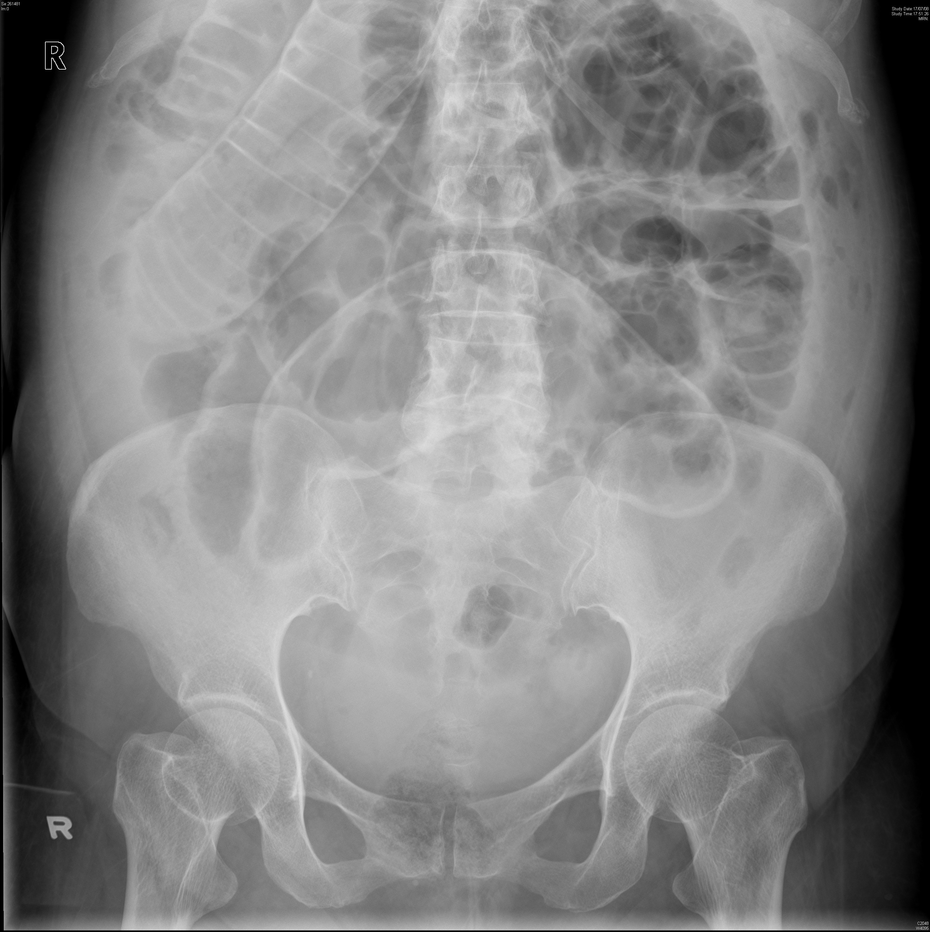 Normal Abdominal X Ray