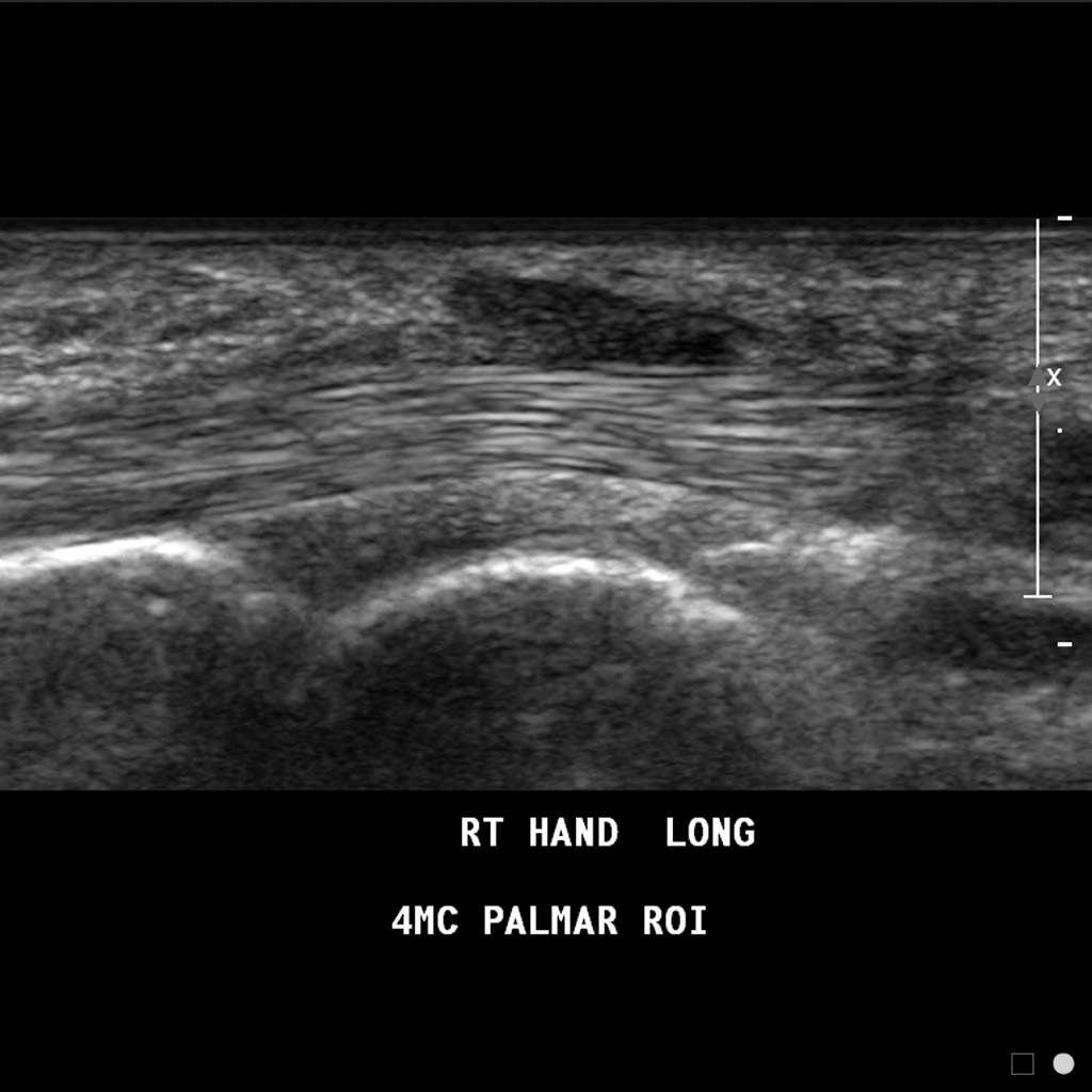 Узи кисти. Контрактура Дюпюитрена на УЗИ. Контрактура Дюпюитрена УЗИ картина.