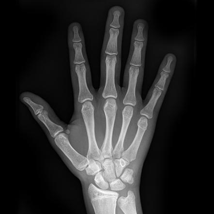 Boxer Fracture Radiology Case Radiopaedia Org