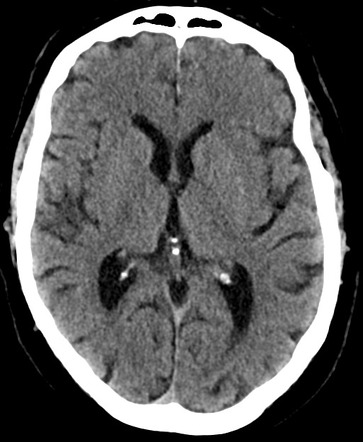 Cavernous sinus meningioma | Radiology Case | Radiopaedia.org