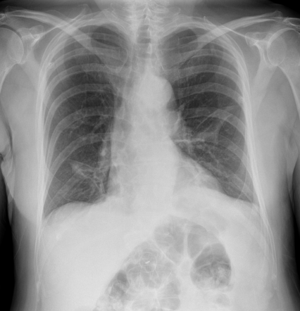 Dislodged PFO closure device | Radiology Case | Radiopaedia.org