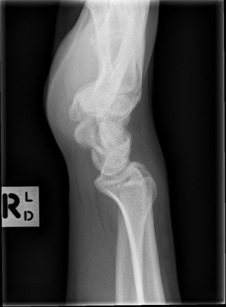 Scaphoid series (summary) | Radiology Reference Article | Radiopaedia.org