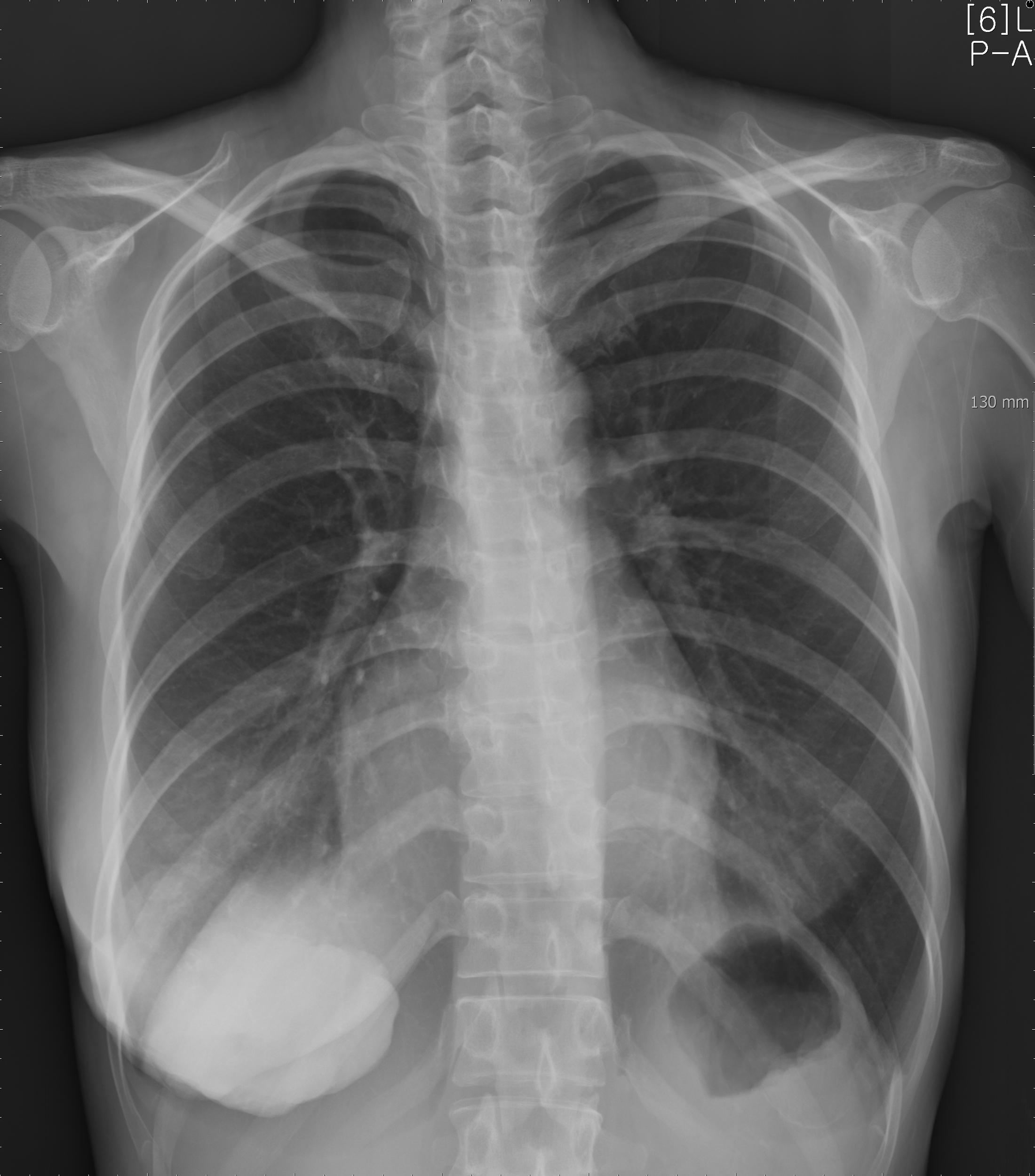 PA Chest X Ray