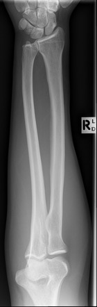 Normal Forearm X Ray