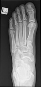 Foot (dorsoplantar view) | Radiology Reference Article | Radiopaedia.org