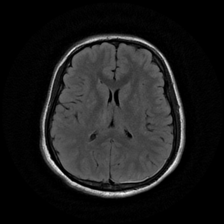 Cerebral fat embolism | Image | Radiopaedia.org