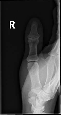 Thumb series (summary) | Radiology Reference Article | Radiopaedia.org