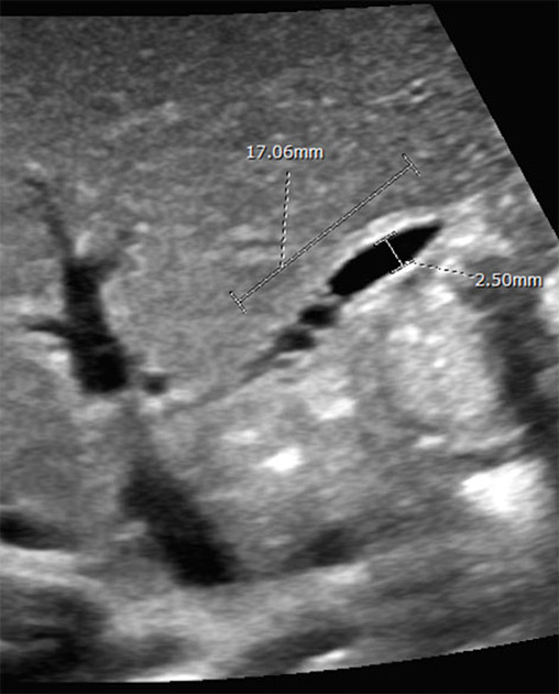 Radiology Quiz 37539 Radiopaedia Orgviewing Playlist Biliary Atresia Radiopaedia Org