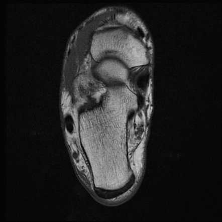 Baxter neuropathy | Image | Radiopaedia.org