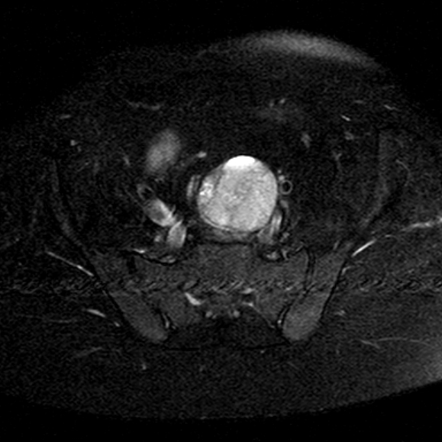 Viewing Playlist Mri Spine Radiopaedia Org